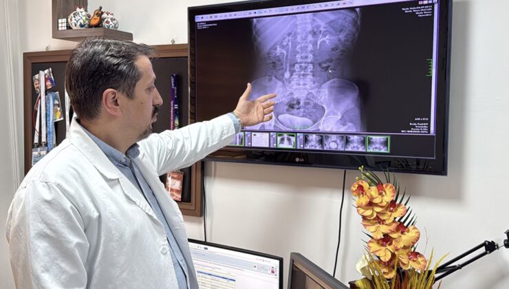 İdrar kanalından çıkan 51 taş, doktorları bile şaşkına çevirdi