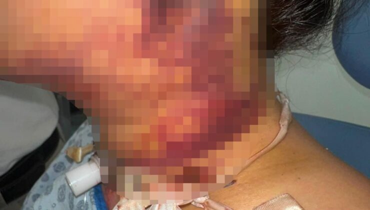 Antalya’da Gıdı Estetiği Sonrası Kabus: Kadın Yoğun Bakıma Kaldırıldı, Doktora 5 Milyon TL’lik Tazminat Davası Açtı