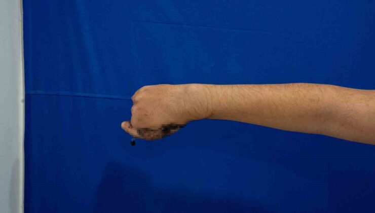 Avcılar’da kıyma makinesine 5 parmağını kaptıran çocuğa ayaktan başparmak nakledildi